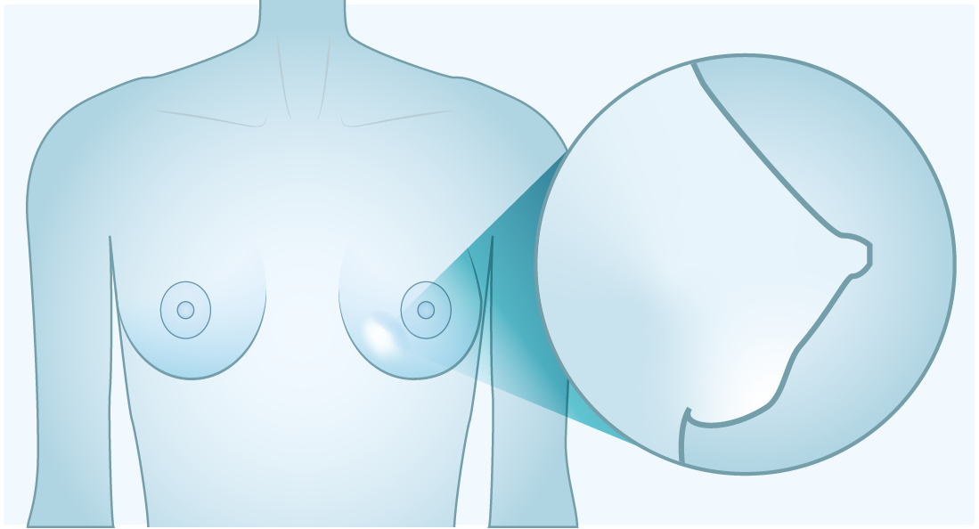 lump or node found inside the breast